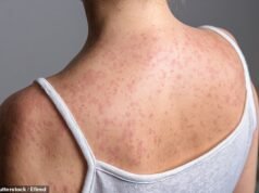 Brote de sarampión golpea escuelas y guarderías del norte de Londres con más de 60 niños infectados