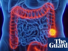 ¿Qué es el cáncer colorrectal y se puede prevenir? | Bueno, en realidad