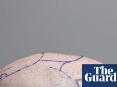 Cabello expuesto: dentro de la capital mundial de los trasplantes – reportaje fotográfico | cabello para hombres