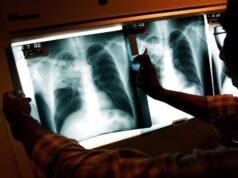 Por qué el Área de la Bahía es un foco de tuberculosis