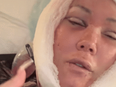 La esposa de Jelly Roll, Bunnie Xo, revela una brutal recuperación del estiramiento facial