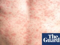 ¿Qué tan contagioso es el sarampión y cuáles son los síntomas? | Bueno, en realidad